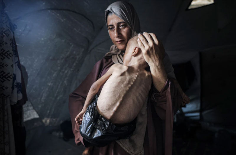 Nino-gazati-con-paralisis-Anadolu hambruna