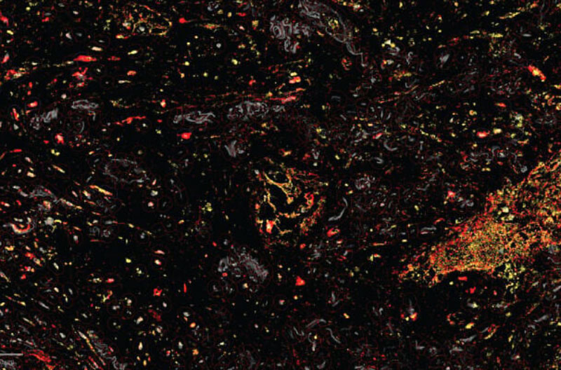 Tejido-de-cancer-de-pulmon-JBN weizmann