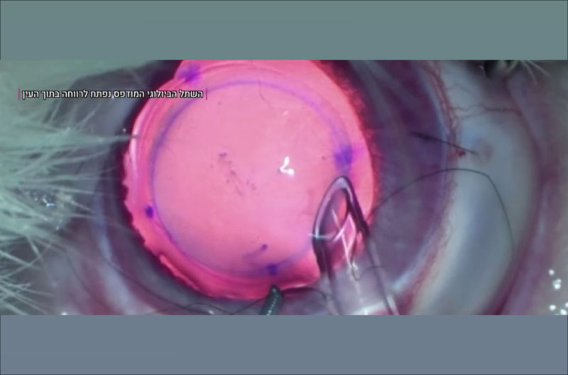 Cornea-3D escasez